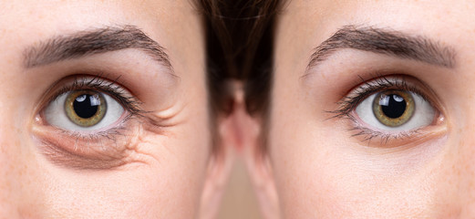 Before and after upper eyelid blepharoplasty