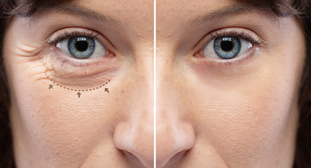 Before and after lower eyelid blepharoplasty