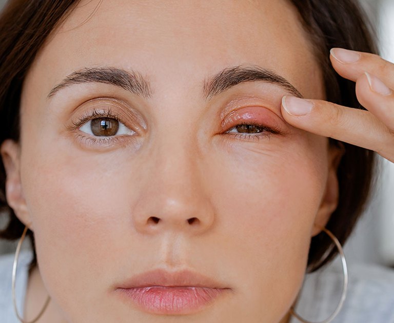 Chalazion (eyelid cyst) on an upper eyelid before removal at Optimal Vision