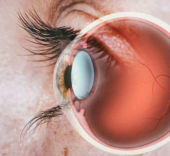 How does Corneal Collagen