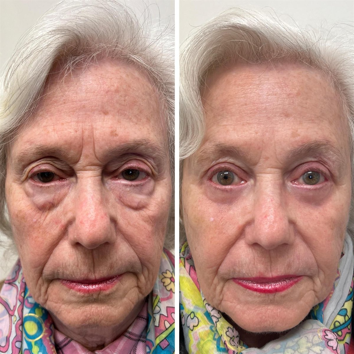 Before and after upper and lower blepharoplasty by Dr Lisa Jagan