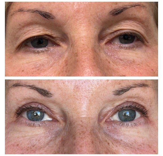 Before and after upper eyelid blepharoplasty by Dr Lisa Jagan