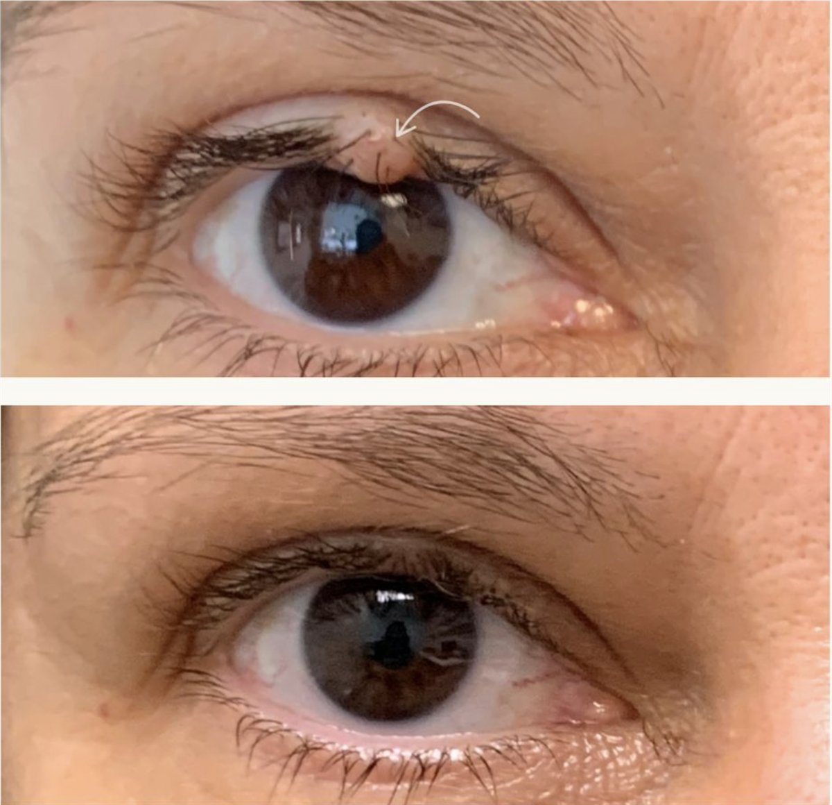 Before and after eyelid mole (intradermal nevus) removal by Dr Lisa Jagan