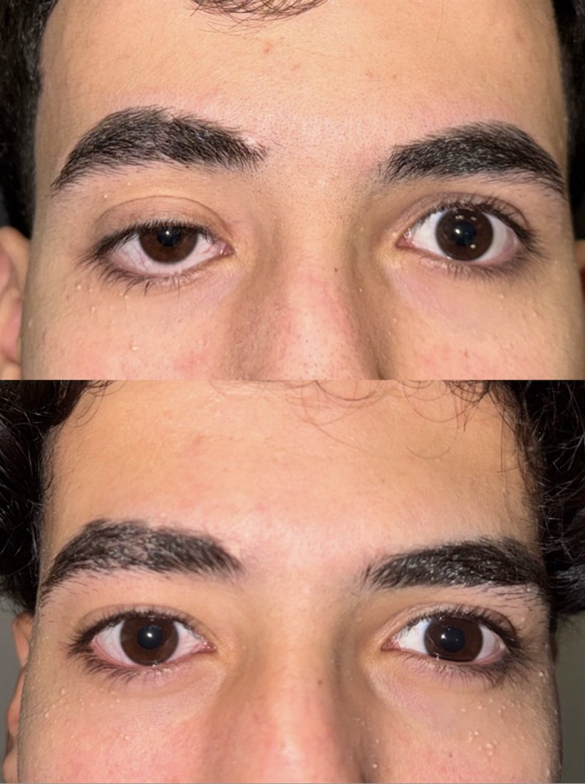 Before and after scarless ptosis repair by Dr Lisa Jagan