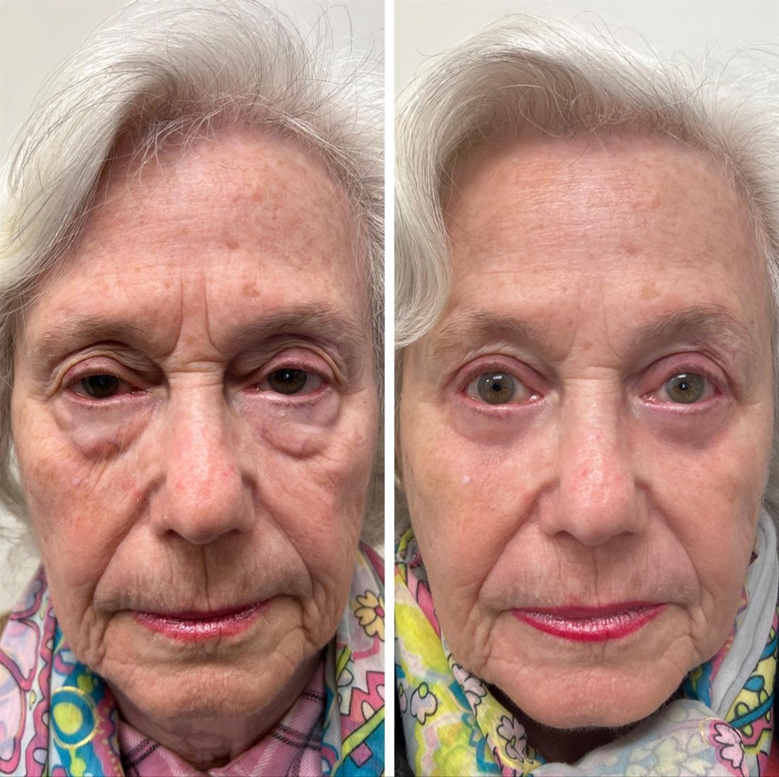 Before and after combination eyelid rejuvenation by Dr Lisa Jagan