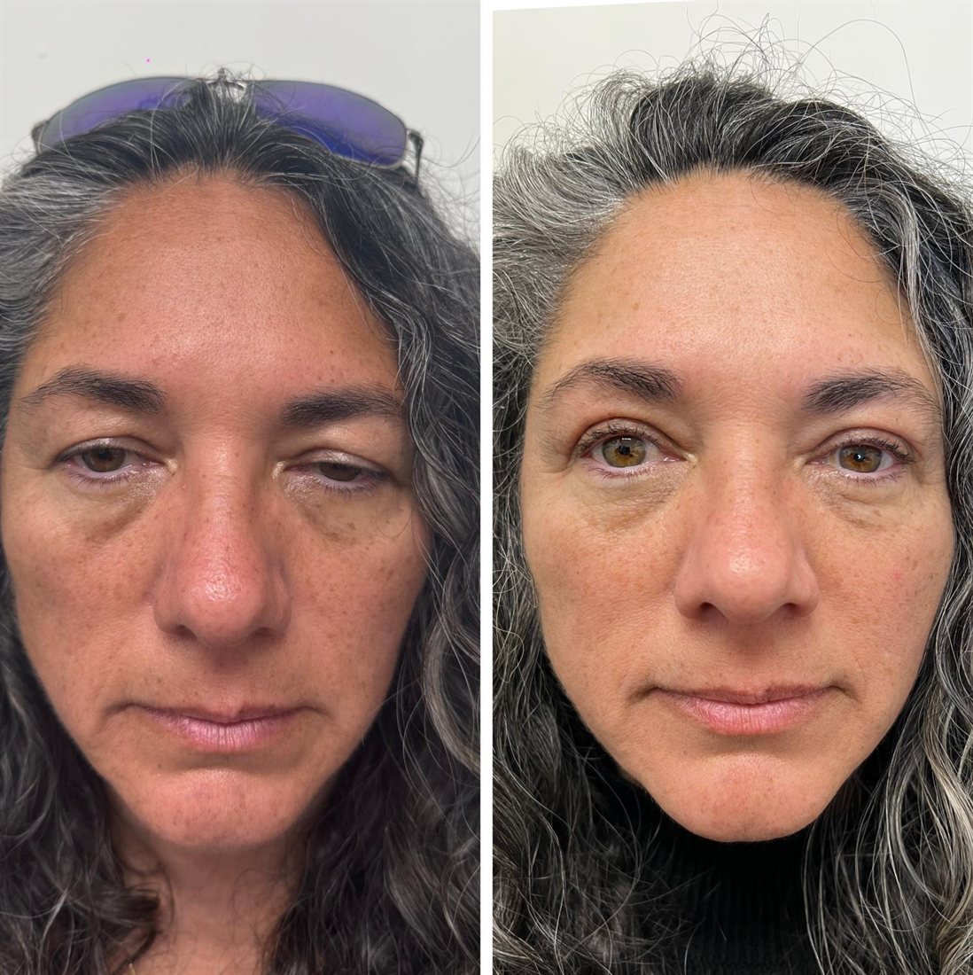 Before and after brow lift, ptosis repair and upper blepharoplasty by Dr Lisa Jagan