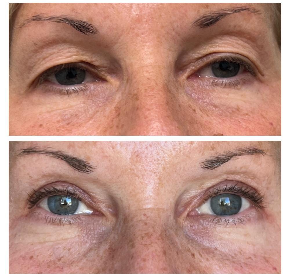 Before and after upper eyelid blepharoplasty by Dr Lisa Jagan