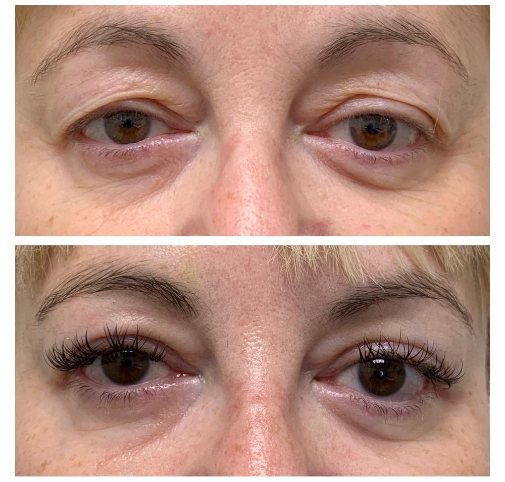 Before and after upper eyelid blepharoplasty by Dr Lisa Jagan