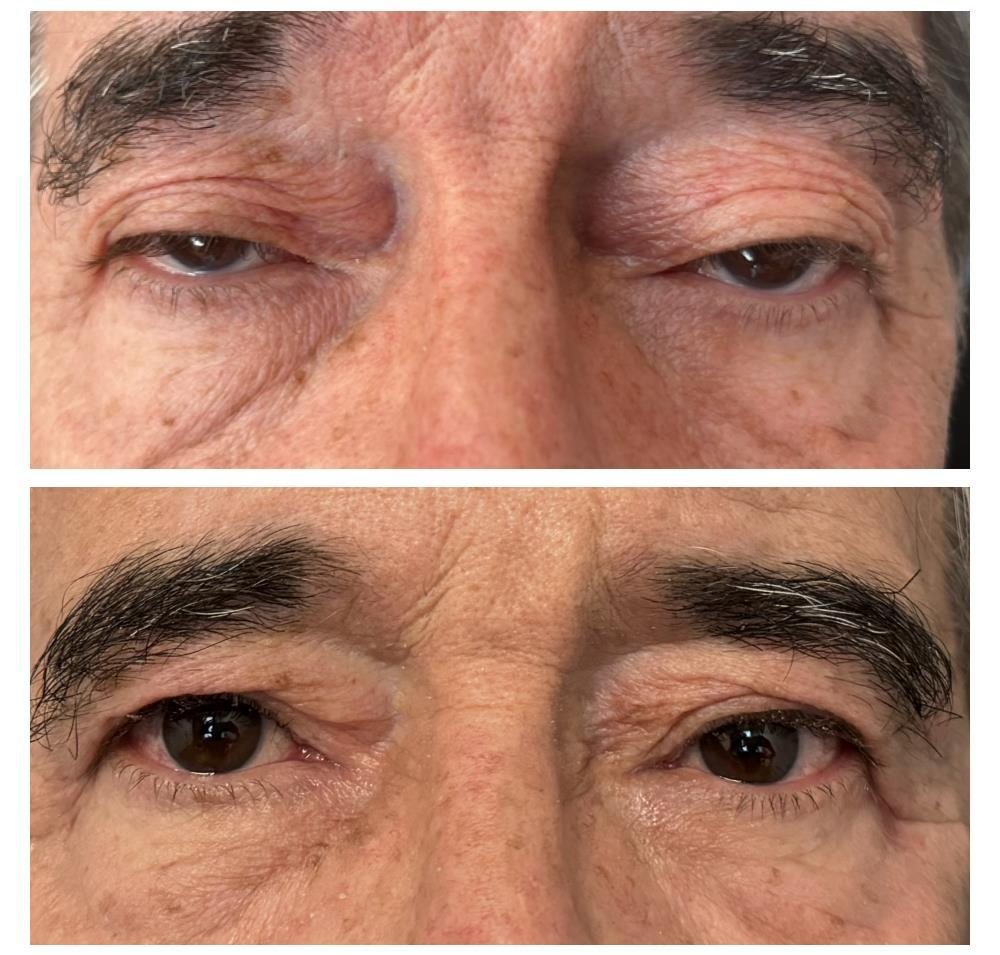 Before and after upper blepharoplasty and ptosis repair by Dr Lisa Jagan