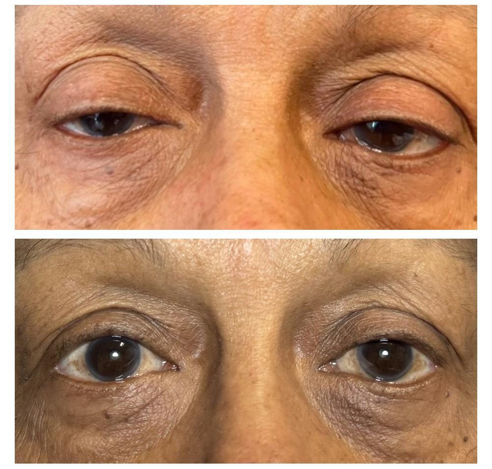 Before and after bilateral ptosis repair by Dr Lisa Jagan