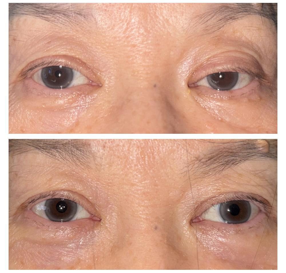 Before and after unilateral ptosis repair by Dr Lisa Jagan