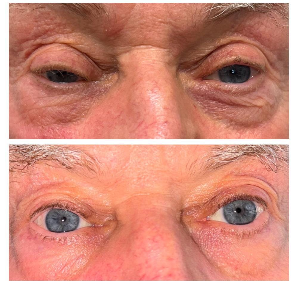 Before and after bilateral ptosis repair by Dr Lisa Jagan