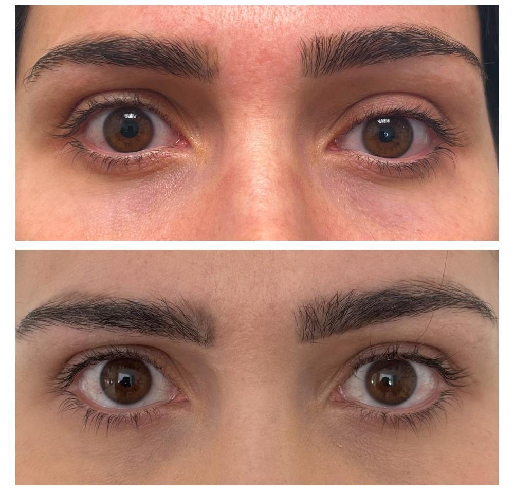 Before and after ptosis repair by Dr Lisa Jagan