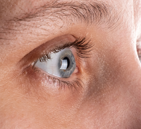 Corneal Collagen Crosslinking Plus