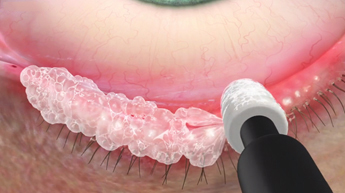 Why choose us for eye surgery