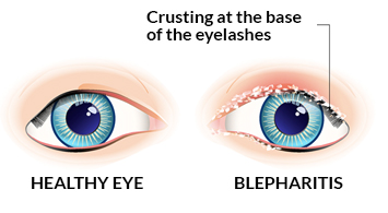 Why choose us for eye surgery