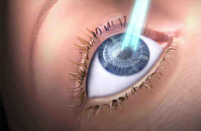 how does laser eye surgery work