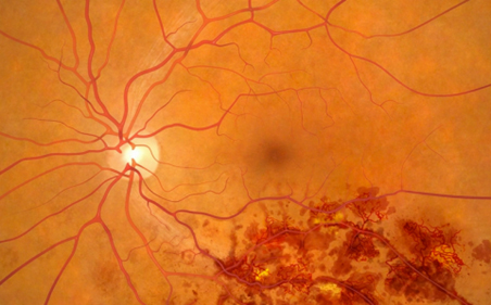 retinal vein